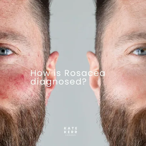 katekerrlondon_facialist Instagram post about Rosacea diagnosis